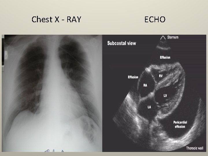 Chest X - RAY ECHO 