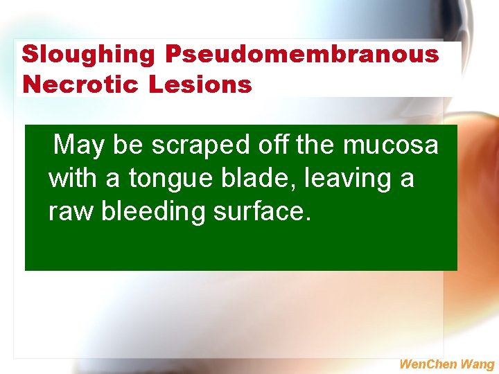 Sloughing Pseudomembranous Necrotic Lesions May be scraped off the mucosa with a tongue blade,