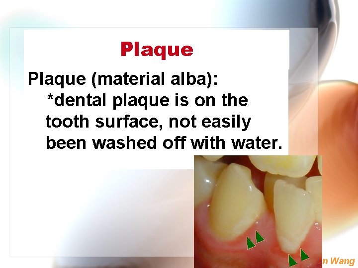 Plaque (material alba): *dental plaque is on the tooth surface, not easily been washed