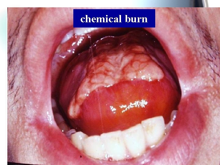 chemical burn Wen. Chen Wang 