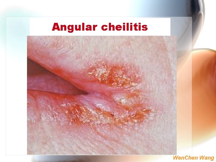 Angular cheilitis Wen. Chen Wang 