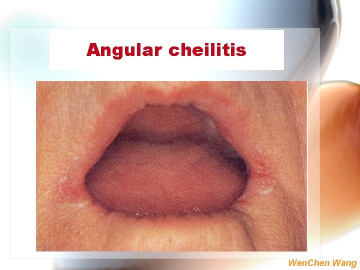Angular cheilitis Wen. Chen Wang 