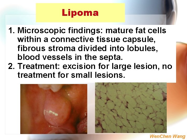 Lipoma 1. Microscopic findings: mature fat cells within a connective tissue capsule, fibrous stroma