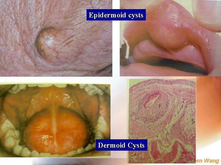 Epidermoid cysts Dermoid Cysts Wen. Chen Wang 