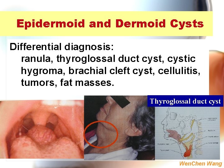 Epidermoid and Dermoid Cysts Differential diagnosis: ranula, thyroglossal duct cyst, cystic hygroma, brachial cleft