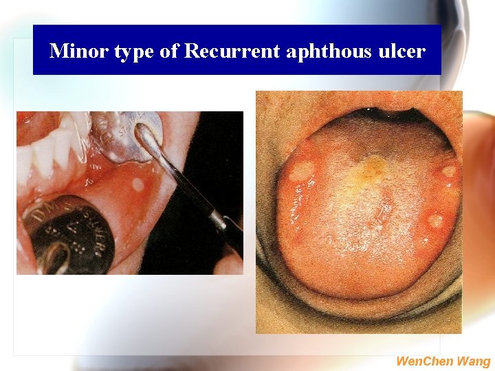 Minor type of Recurrent aphthous ulcer Wen. Chen Wang 