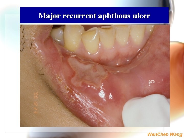 Major recurrent aphthous ulcer Wen. Chen Wang 