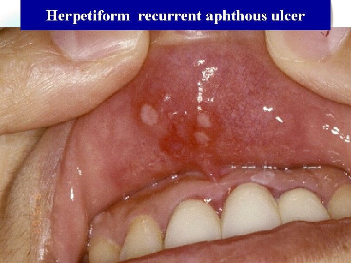 Herpetiform recurrent aphthous ulcer Wen. Chen Wang 