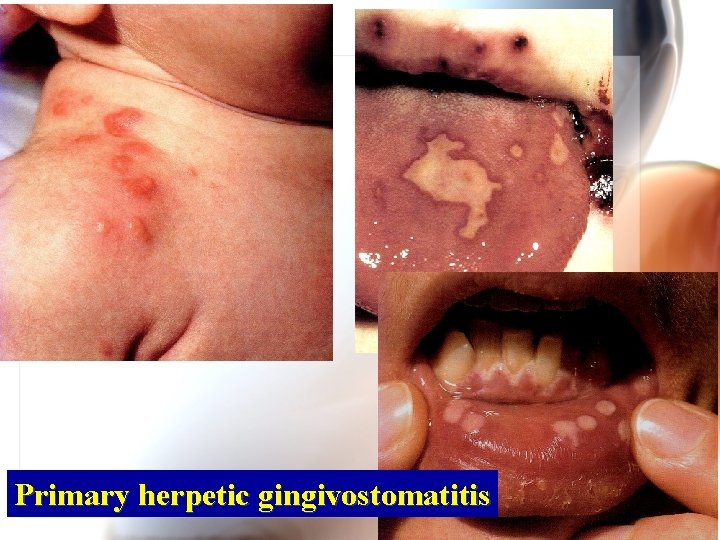 Primary herpetic gingivostomatitis Wen. Chen Wang 