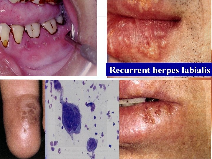 Recurrent herpes labialis Wen. Chen Wang 