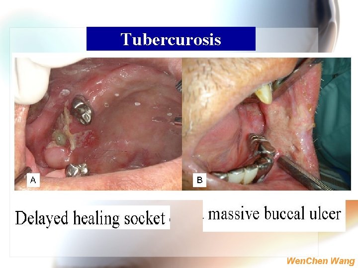 Tubercurosis Wen. Chen Wang 