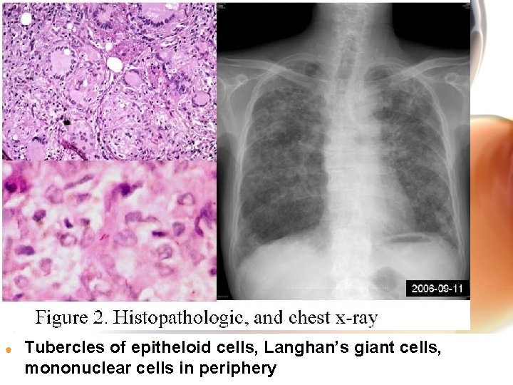 | Tubercles of epitheloid cells, Langhan’s giant cells, mononuclear cells in periphery Wen. Chen