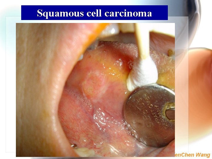 Squamous cell carcinoma Wen. Chen Wang 