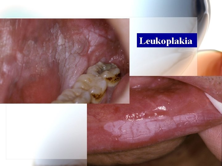 Leukoplakia Wen. Chen Wang 