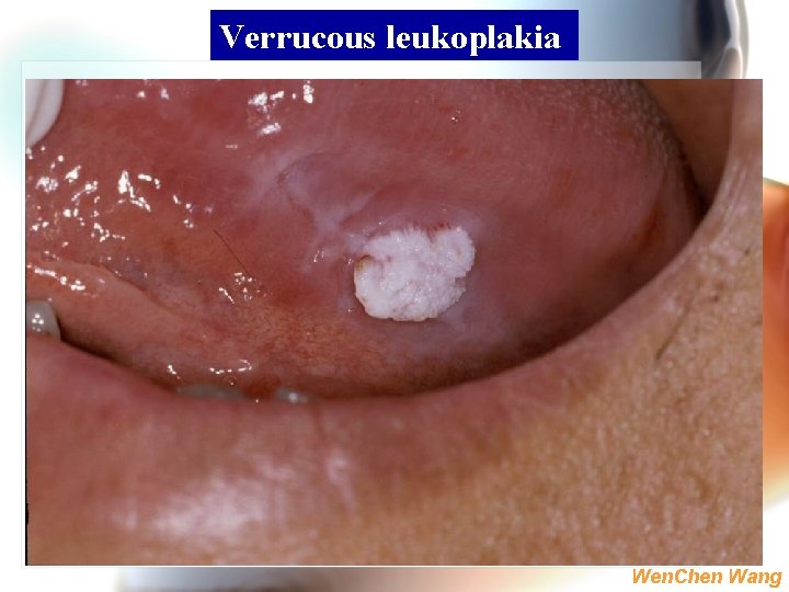 Verrucous leukoplakia Wen. Chen Wang 