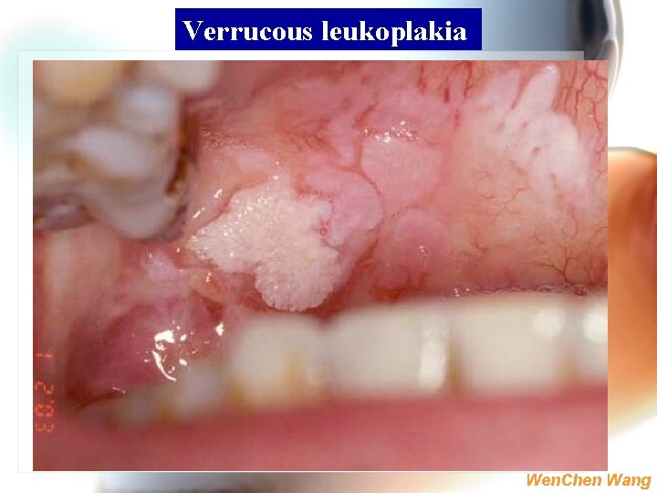 Verrucous leukoplakia Wen. Chen Wang 