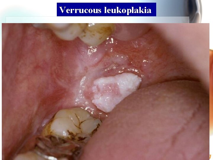 Verrucous leukoplakia Wen. Chen Wang 