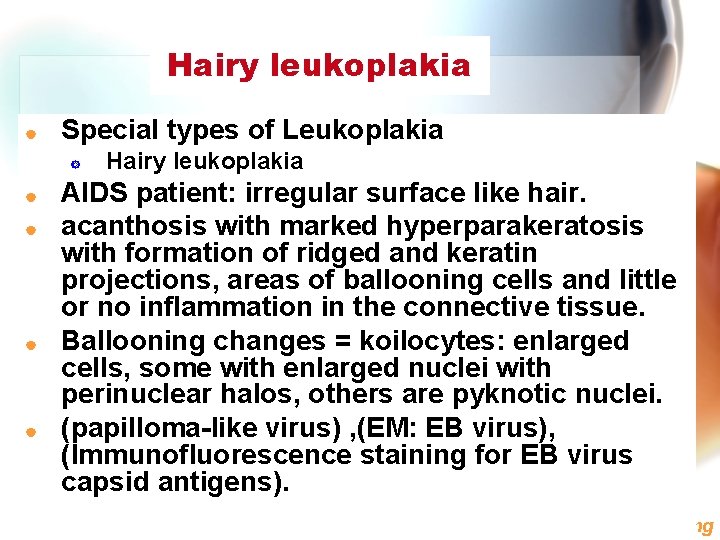 Hairy leukoplakia | Special types of Leukoplakia ] | | Hairy leukoplakia AIDS patient: