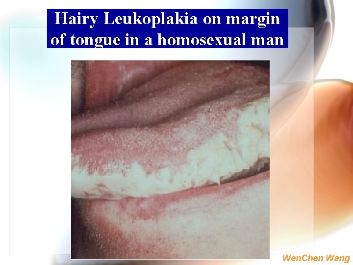 Hairy Leukoplakia on margin of tongue in a homosexual man Wen. Chen Wang 