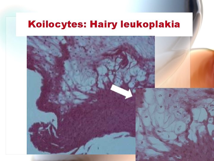 Koilocytes: Hairy leukoplakia Wen. Chen Wang 