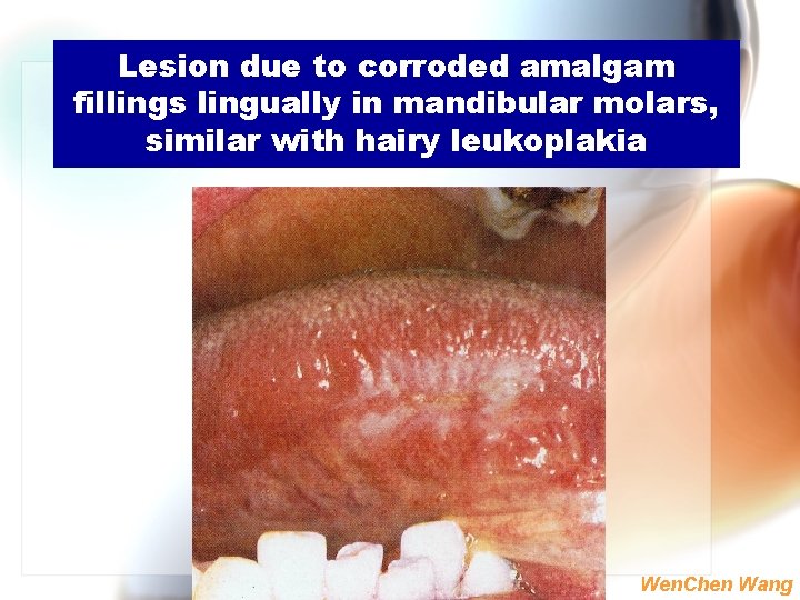 Lesion due to corroded amalgam fillings lingually in mandibular molars, similar with hairy leukoplakia