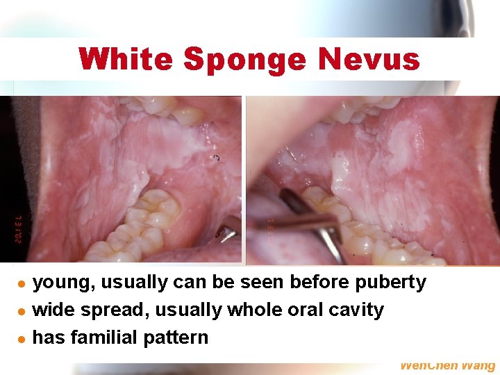 White Sponge Nevus young, usually can be seen before puberty l wide spread, usually