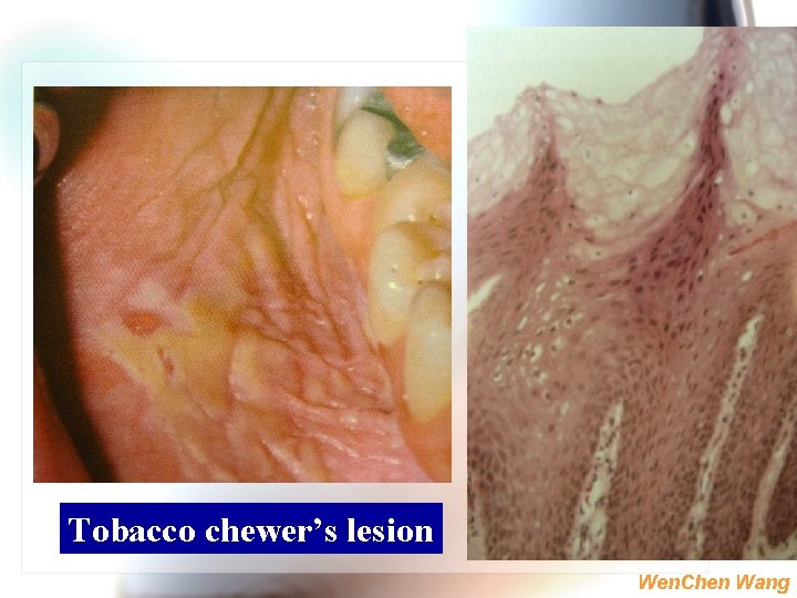 Tobacco chewer’s lesion Wen. Chen Wang 