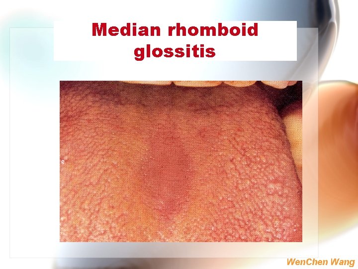 Median rhomboid glossitis Wen. Chen Wang 