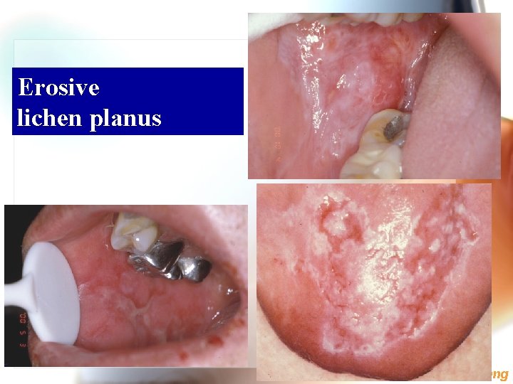 Erosive lichen planus Wen. Chen Wang 
