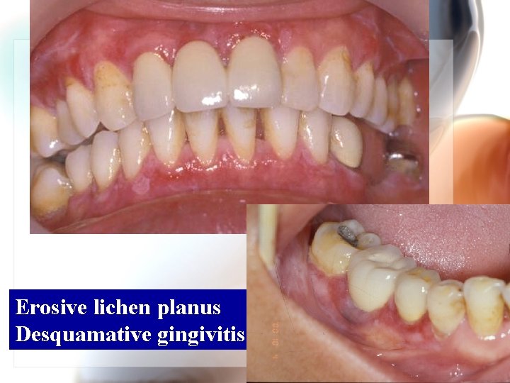 Erosive lichen planus Desquamative gingivitis Wen. Chen Wang 