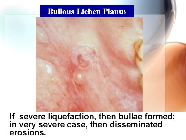 Bullous Lichen Planus If severe liquefaction, then bullae formed; in very severe case, then