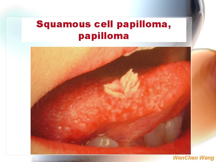 Squamous cell papilloma, papilloma Wen. Chen Wang 