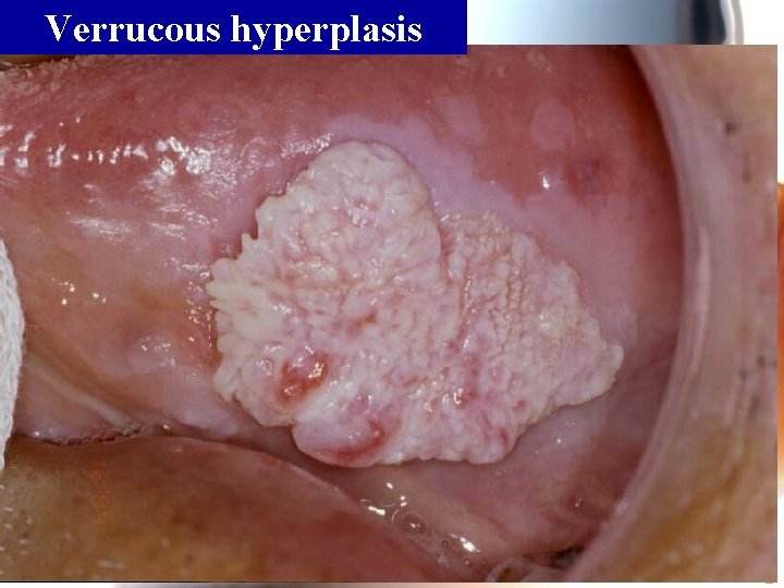 Verrucous hyperplasis Wen. Chen Wang 