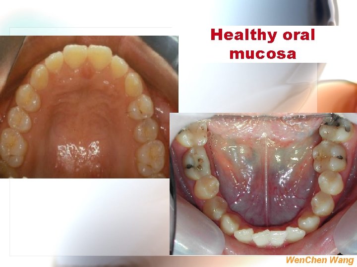 Healthy oral mucosa Wen. Chen Wang 