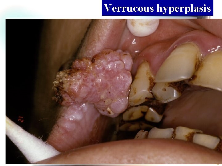 Verrucous hyperplasis Wen. Chen Wang 