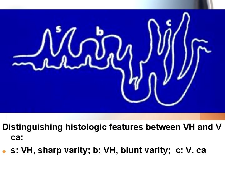 Distinguishing histologic features between VH and V ca: | s: VH, sharp varity; b: