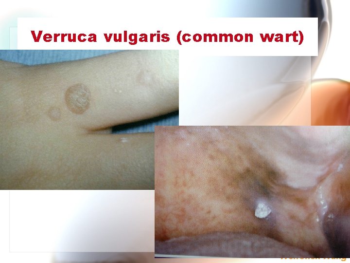 Verruca vulgaris (common wart) Wen. Chen Wang 