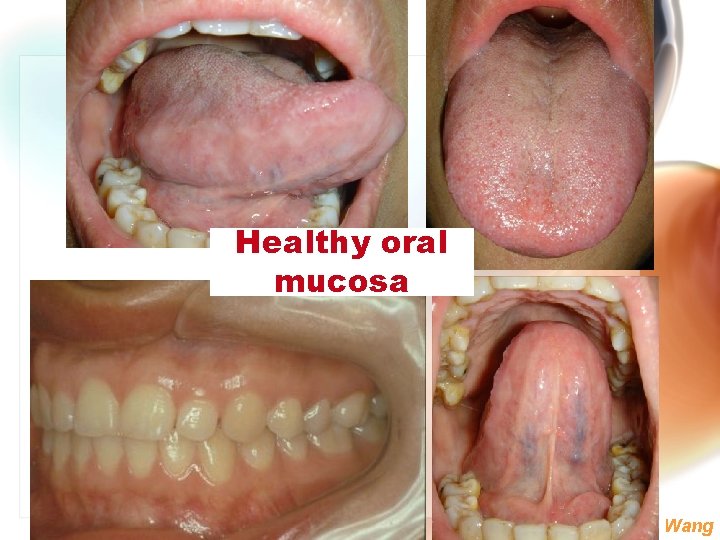 Healthy oral mucosa Wen. Chen Wang 