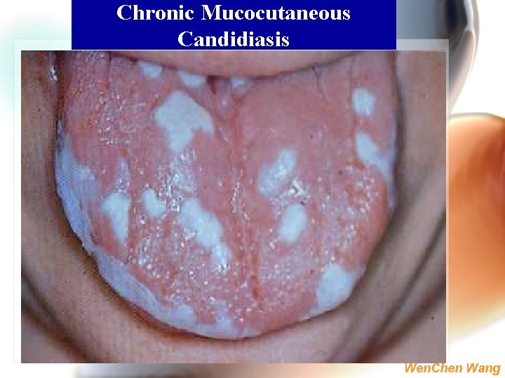 Chronic Mucocutaneous Candidiasis Wen. Chen Wang 