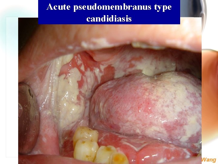 Acute pseudomembranus type candidiasis Wen. Chen Wang 