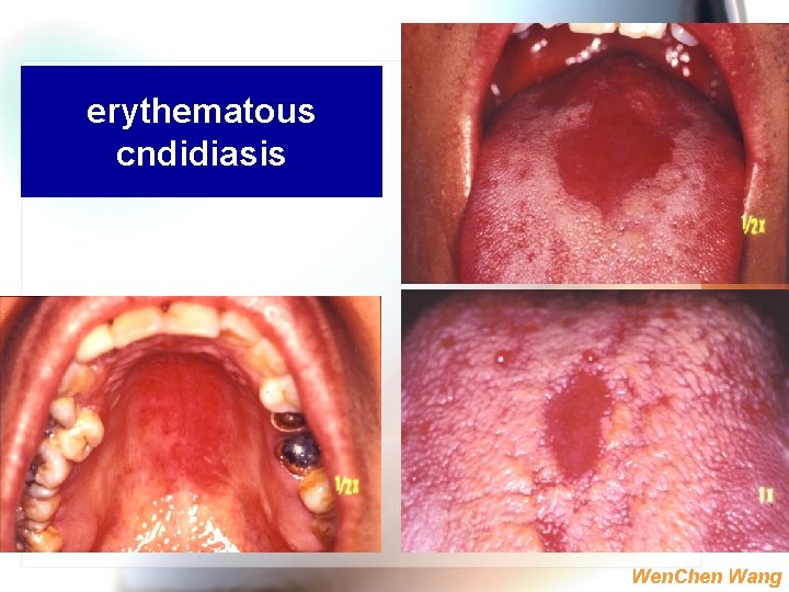 erythematous cndidiasis Wen. Chen Wang 