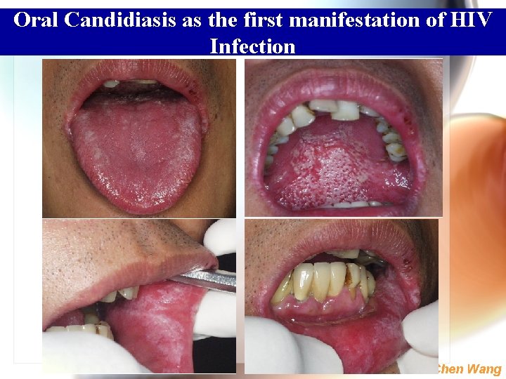 Oral Candidiasis as the first manifestation of HIV Infection Wen. Chen Wang 