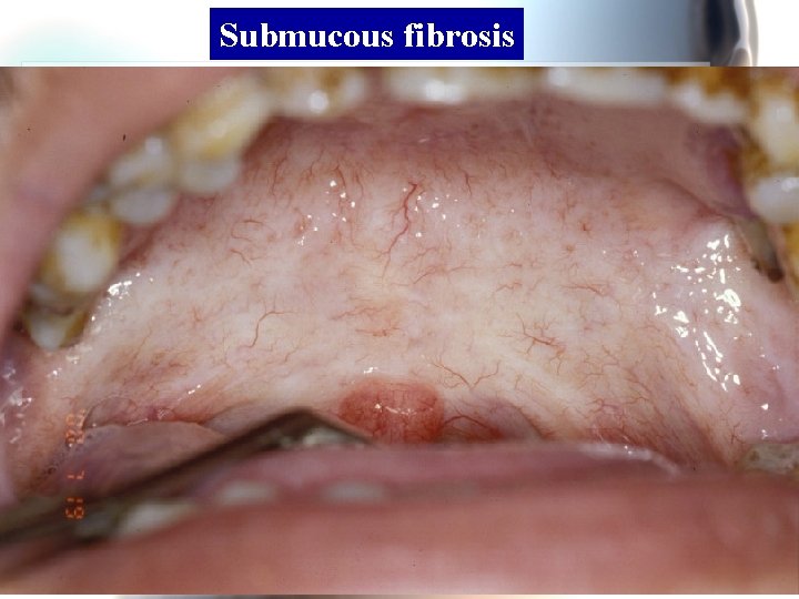 Submucous fibrosis Wen. Chen Wang 