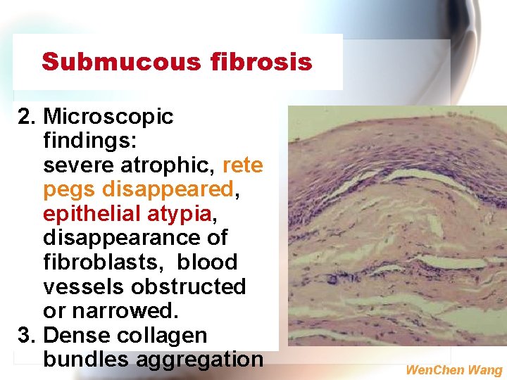 Submucous fibrosis 2. Microscopic findings: severe atrophic, rete pegs disappeared, epithelial atypia, disappearance of