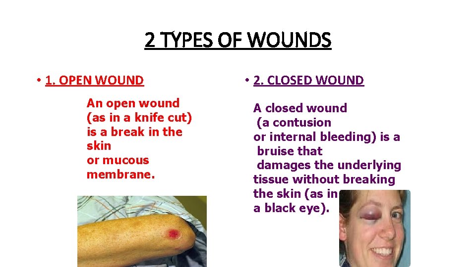 2 TYPES OF WOUNDS • 1. OPEN WOUND An open wound (as in a