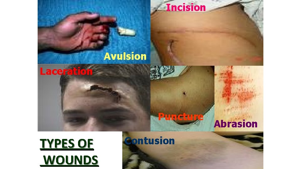Incision Avulsion Laceration Puncture TYPES OF WOUNDS Contusion Abrasion 