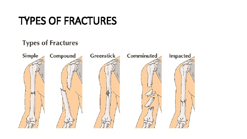 TYPES OF FRACTURES 