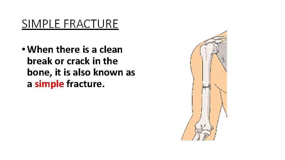 SIMPLE FRACTURE • When there is a clean break or crack in the bone,