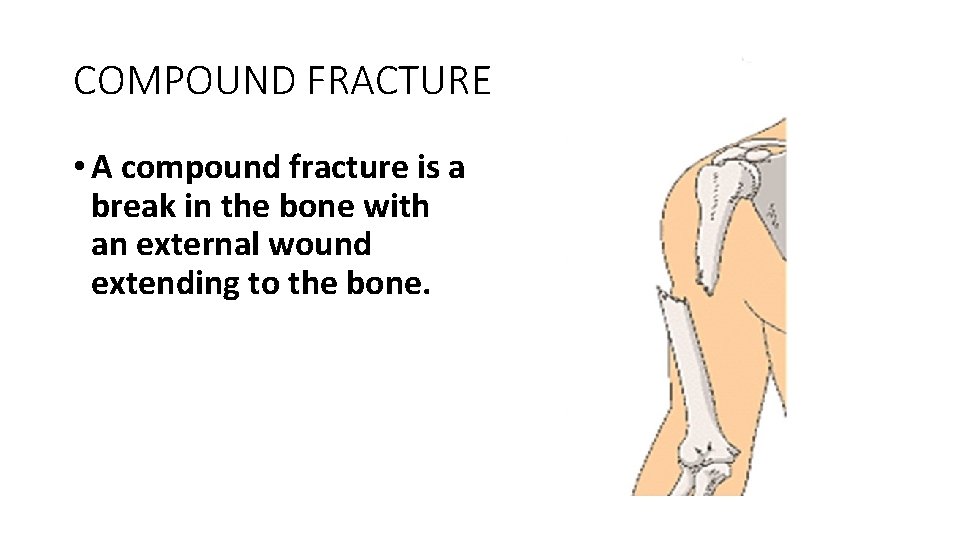 COMPOUND FRACTURE • A compound fracture is a break in the bone with an