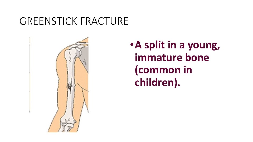 GREENSTICK FRACTURE • A split in a young, immature bone (common in children). 